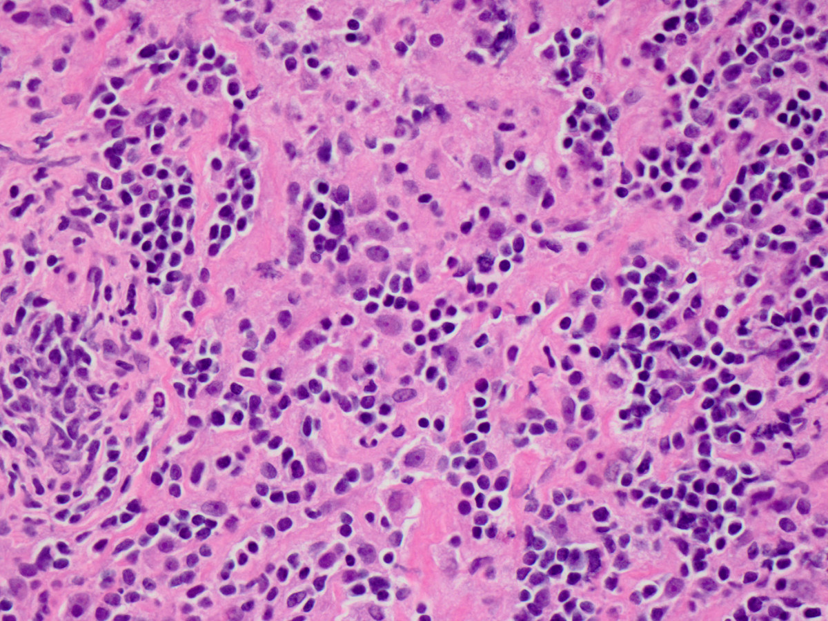 Mediastinal mass post-treatment biopsy (high power)