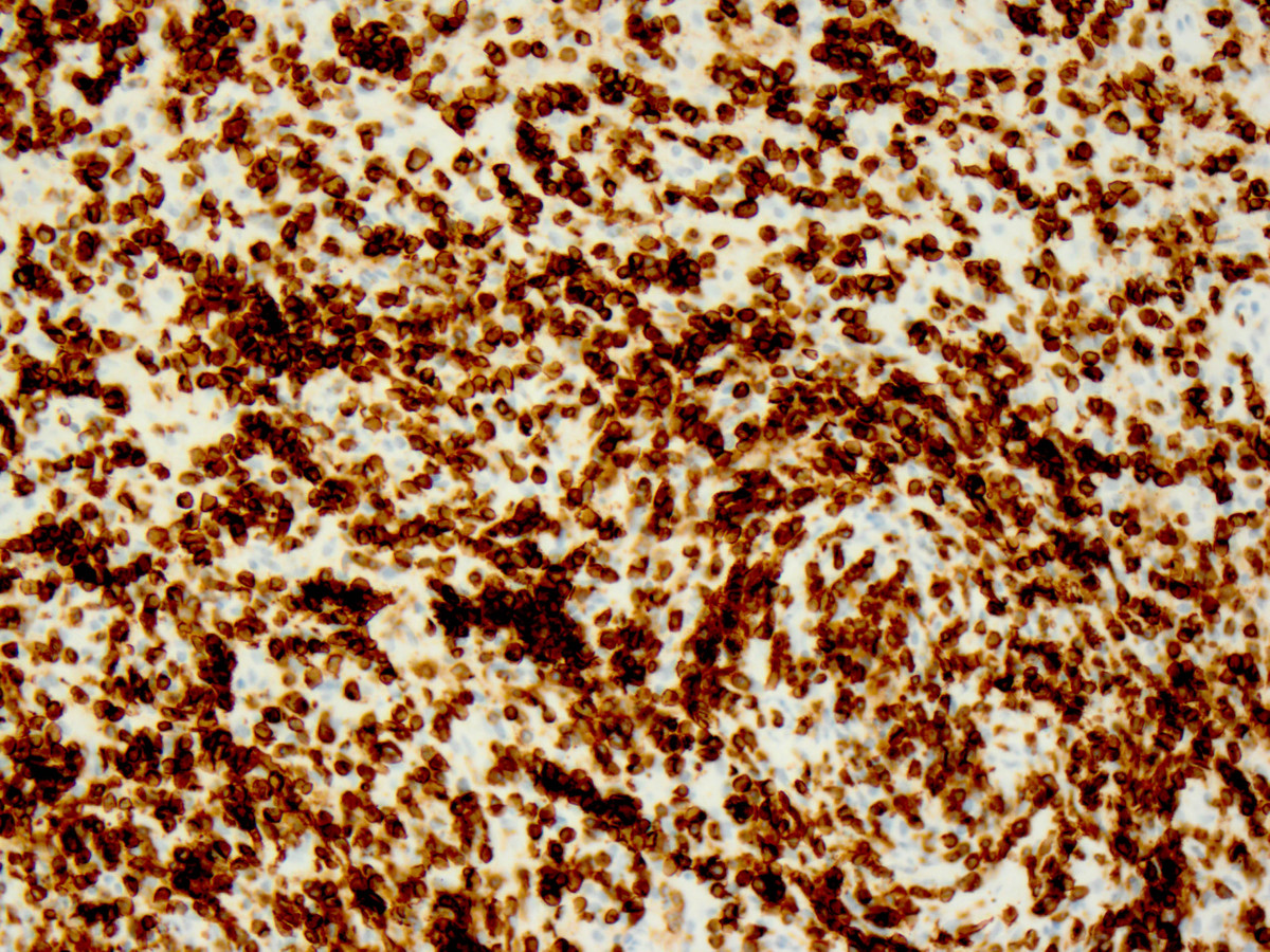 Mediastinal mass post-treatement biopsy (CD3)