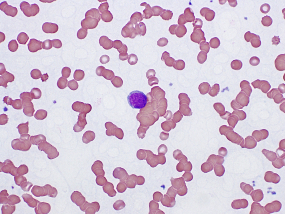 Blast in the peripheral blood