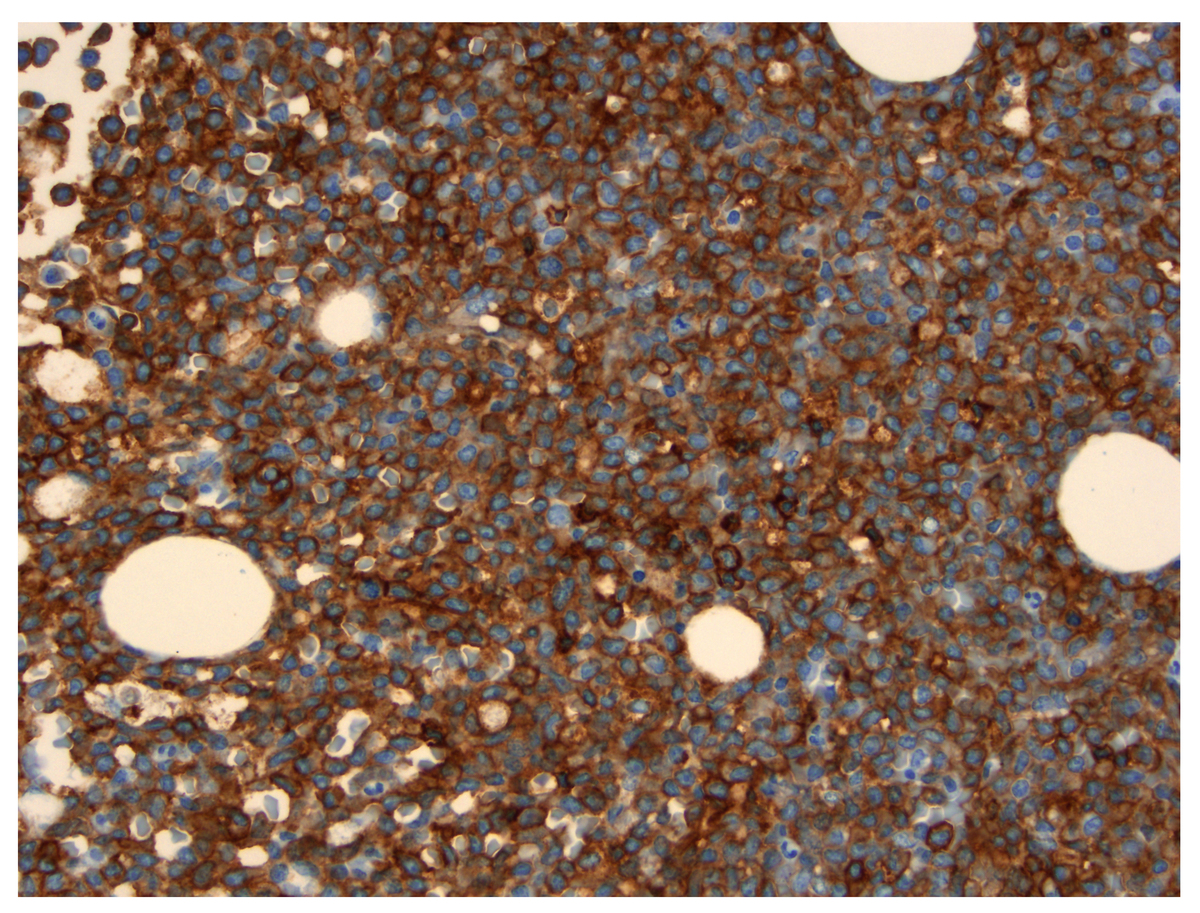 Bone marrow biopsy, anti-CD4 immunostain.