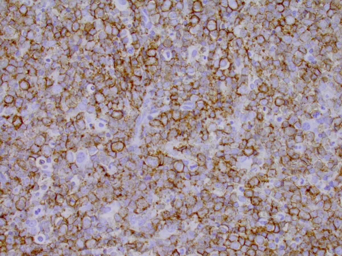 CD20 stain