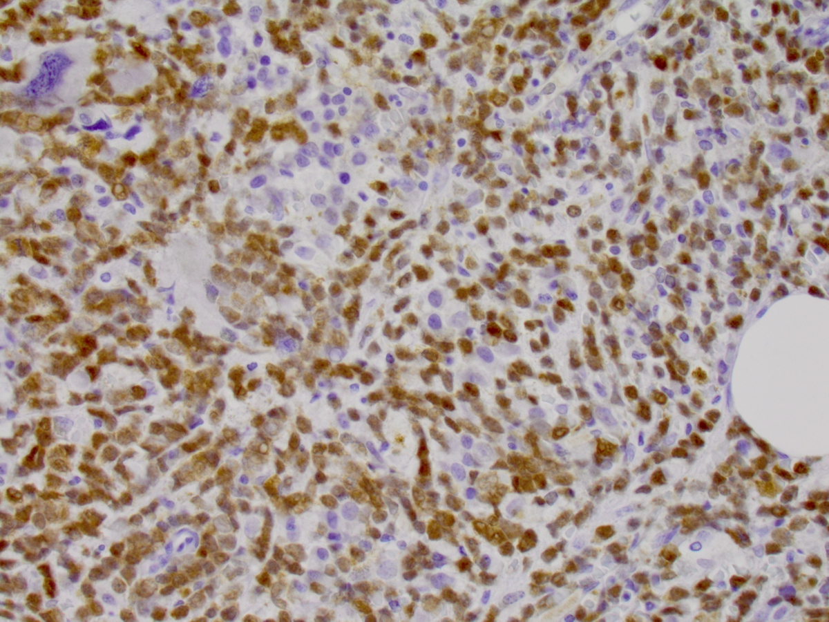 TdT stain