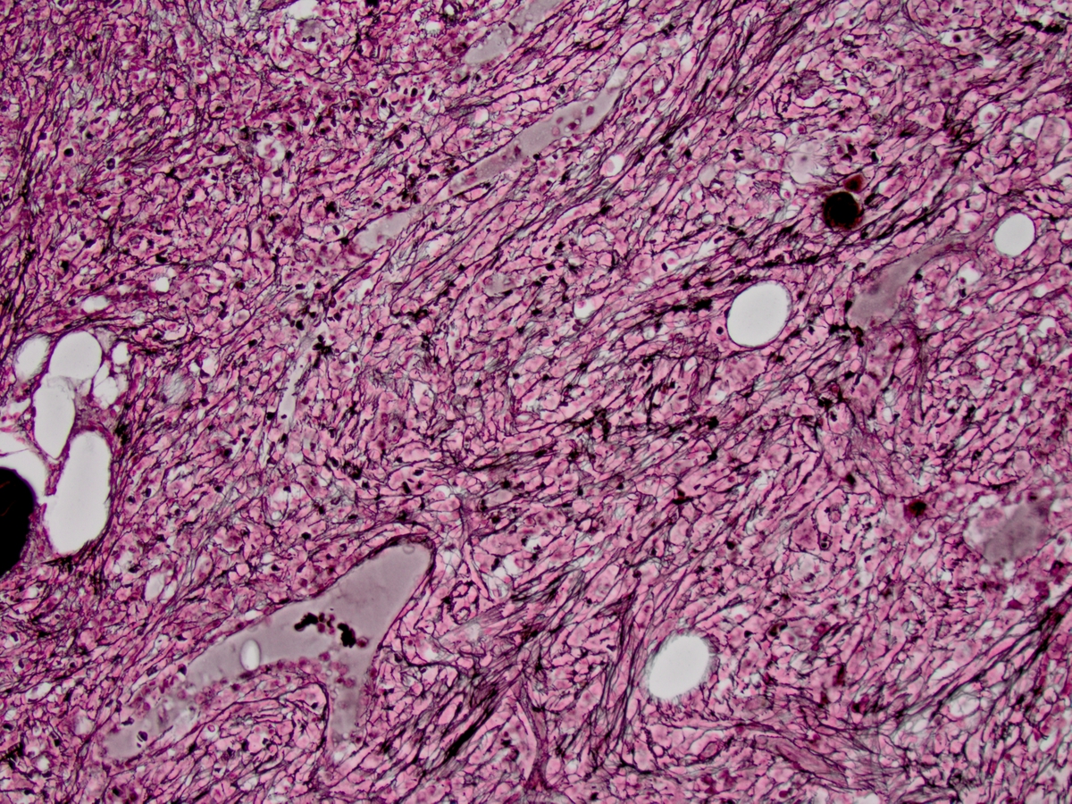 Reticulin with marked fibrosis