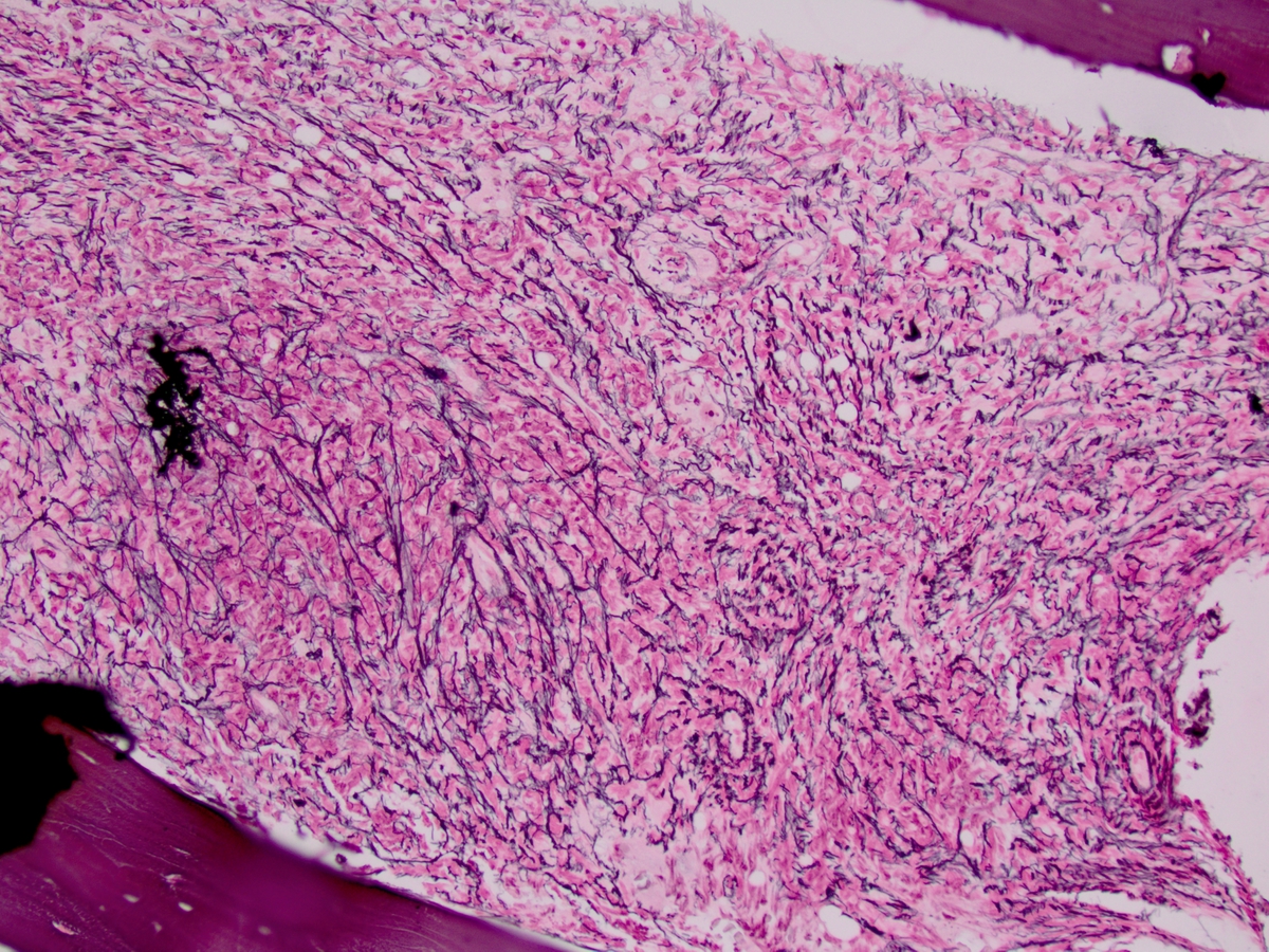 Reticulin stain on the core biopsy