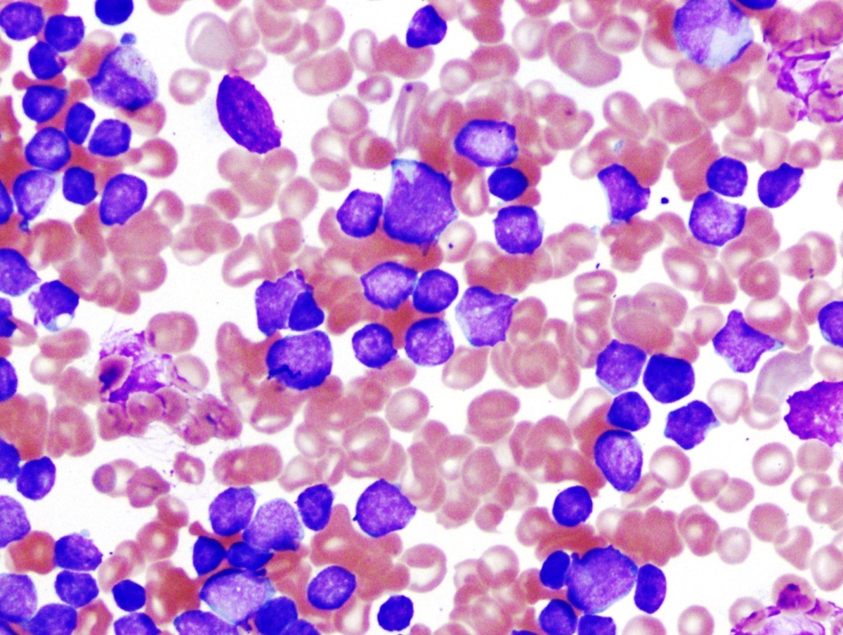 Blasts in the peripheral blood