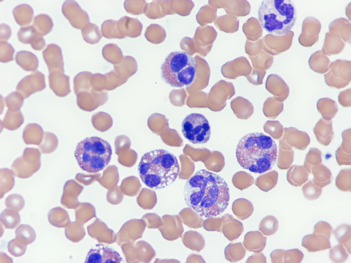 Figure 1. Peripheral blood eosinophilia, 1000X