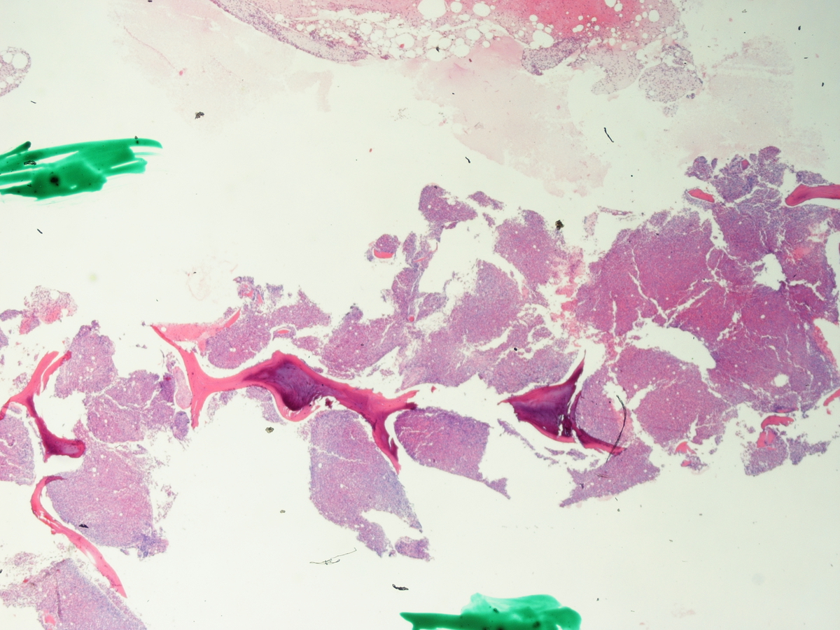 Figure 3. Bone marrow core biopsy, low power (20X)