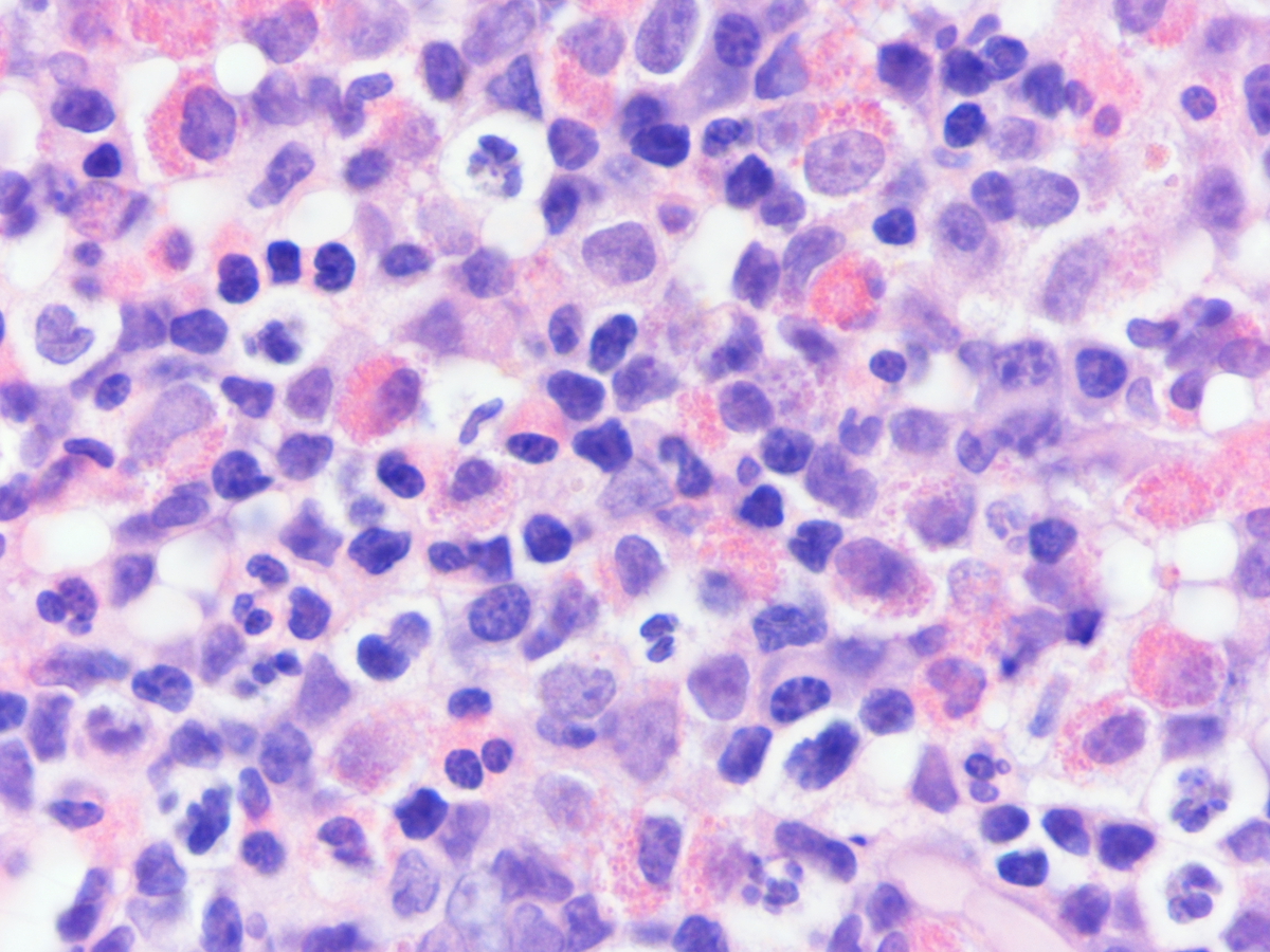Figure 4. Bone marrow core biopsy, high power (400X)
