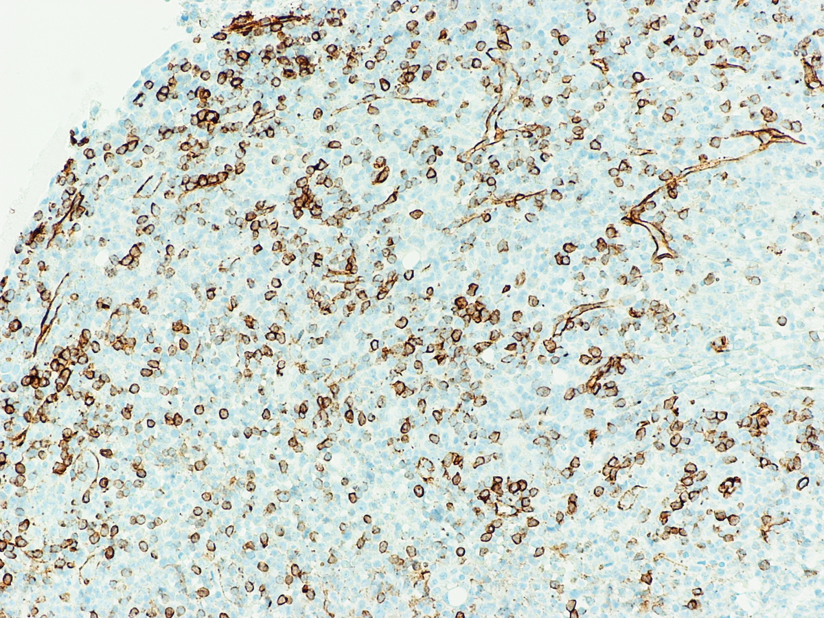 Figure 5. Core biopsy, CD34 (100X)