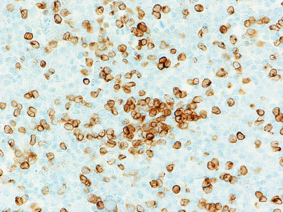 Figure 6) Core biopsy, CD79a (400X)