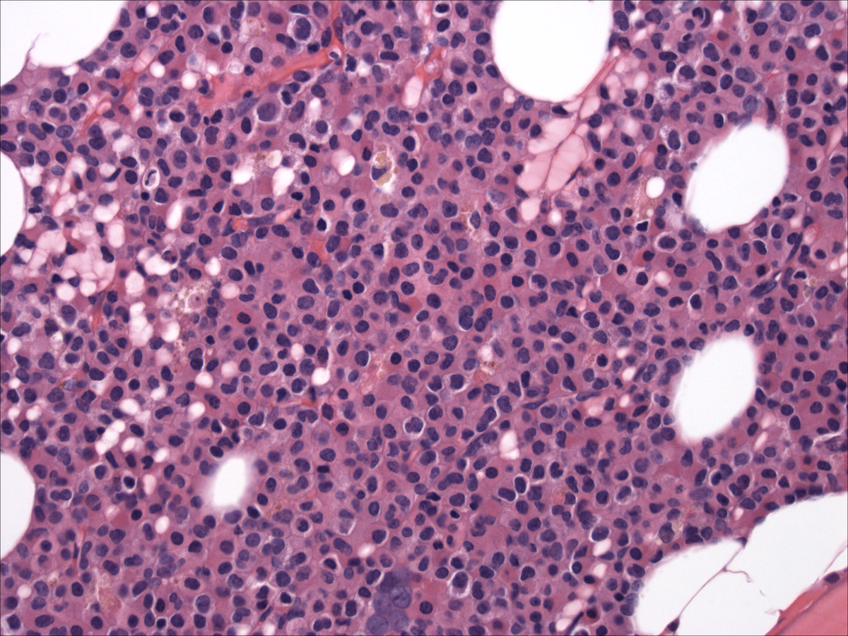 Bone marrow core biopsy