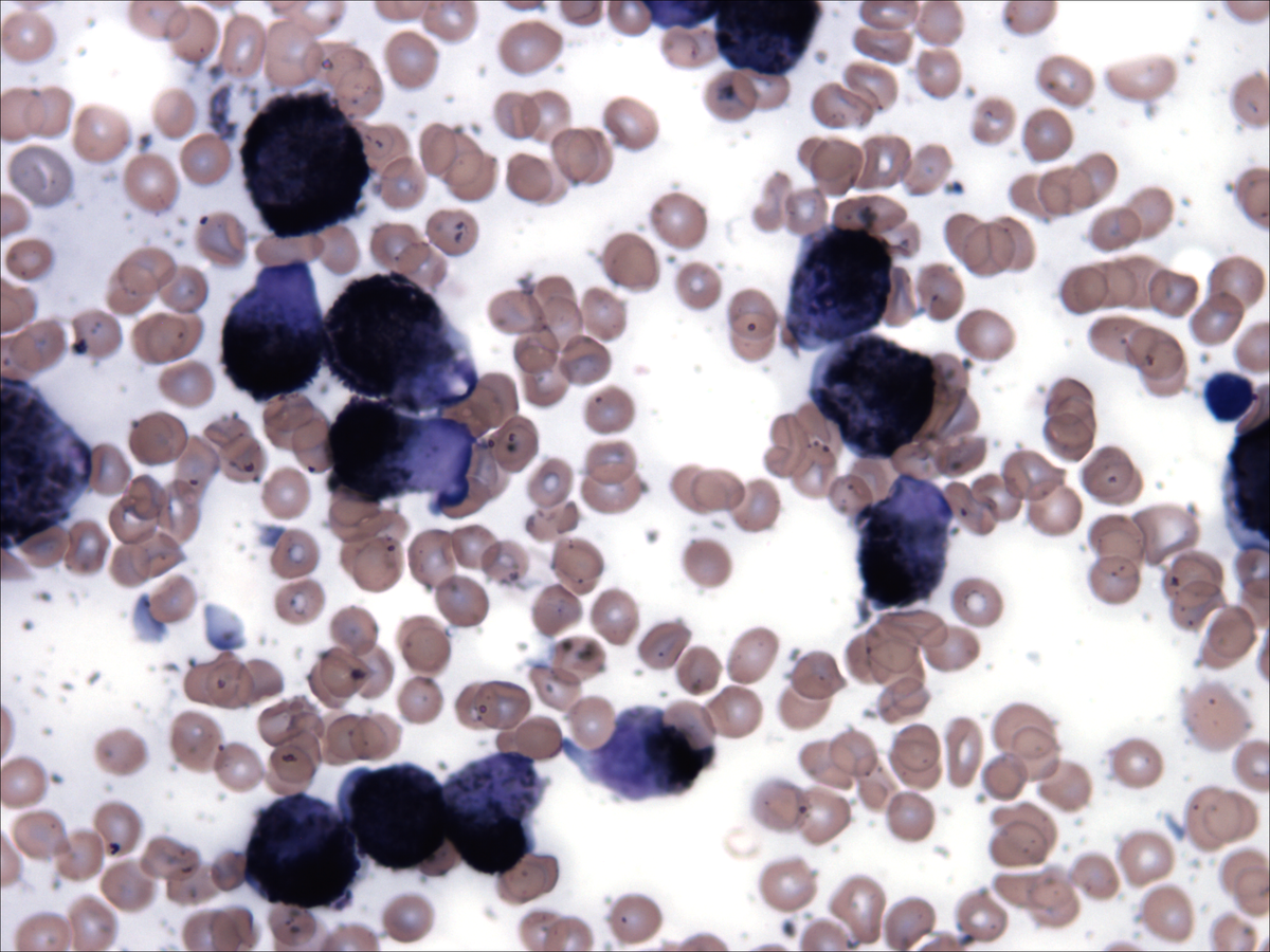 Aspirate smear_myeloperoxidase_counterstain