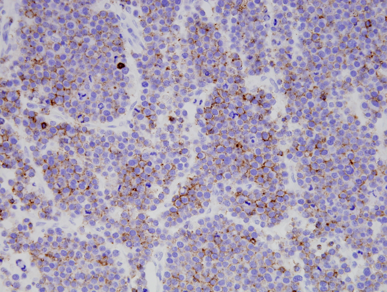 Additional figure 1: CD43 IHC, 400x