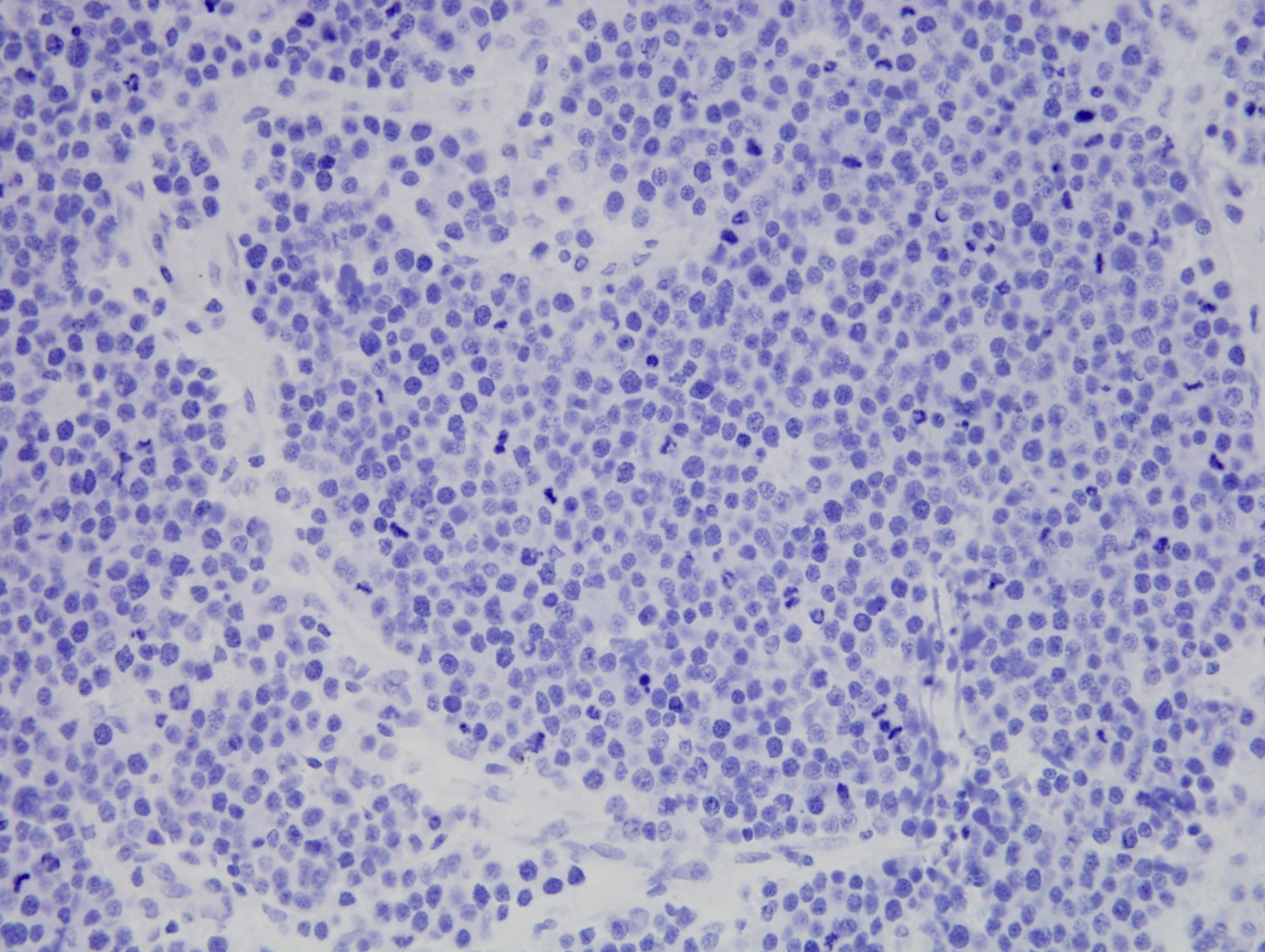 Additional figure 2: E-cadherin IHC, 400x