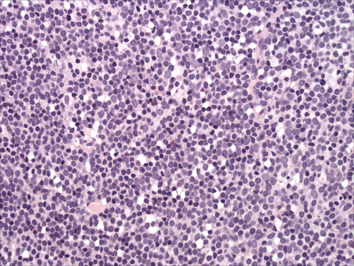 Bone marrow core biopsy 2