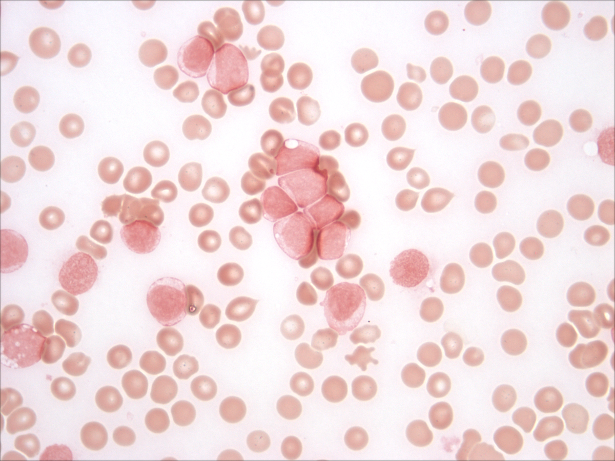 Bone marrow aspirate: myeloperoxidase