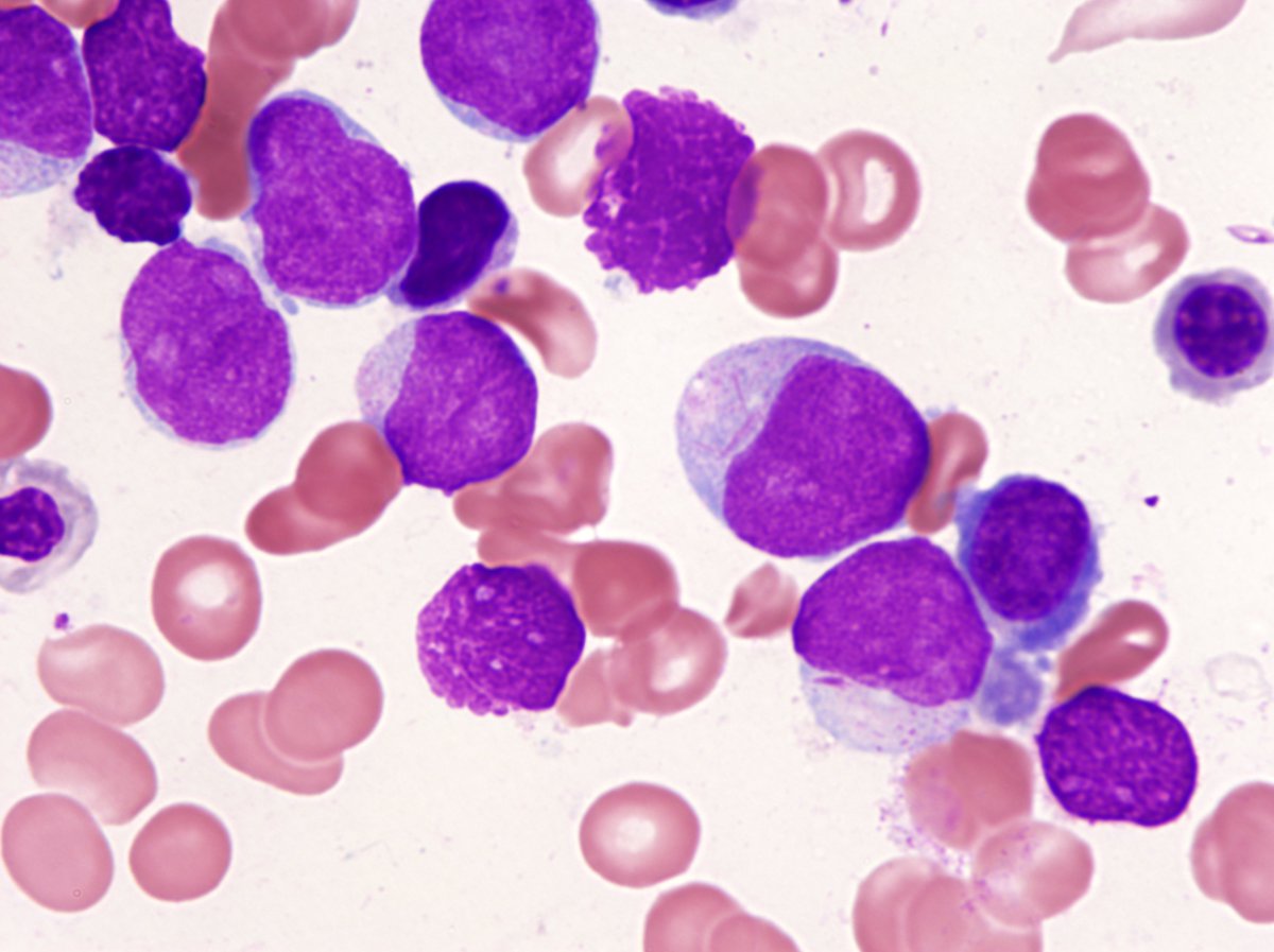 Blasts with Auer rods, BM aspirate 1000X