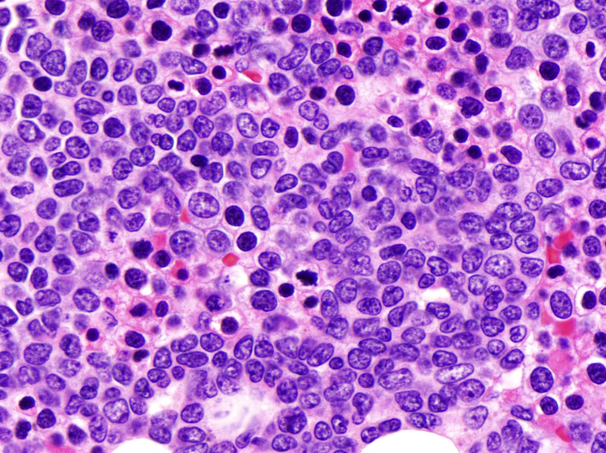 BM biopsy 500X