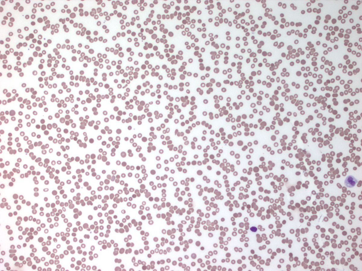  peripheral blood smear