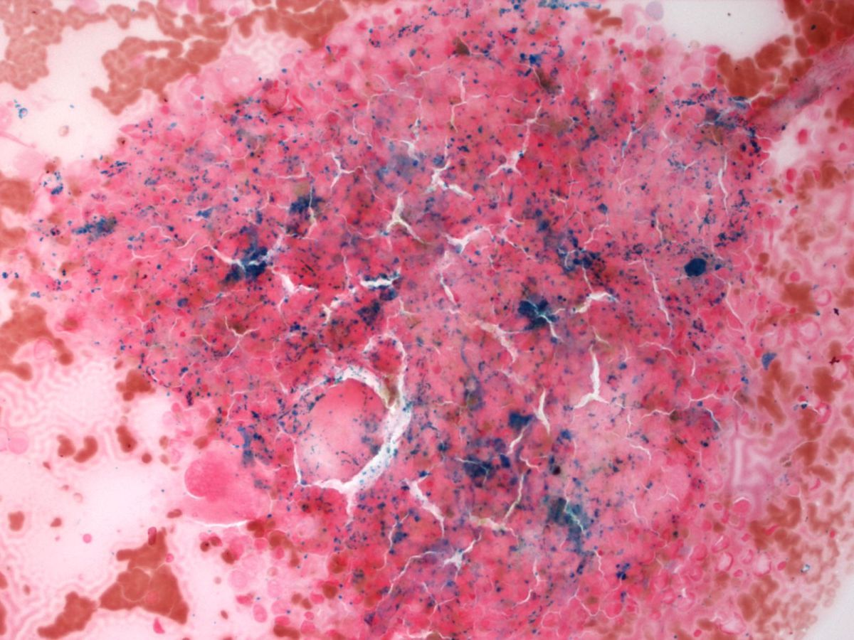 iron stain on bone marrow aspirate smear
