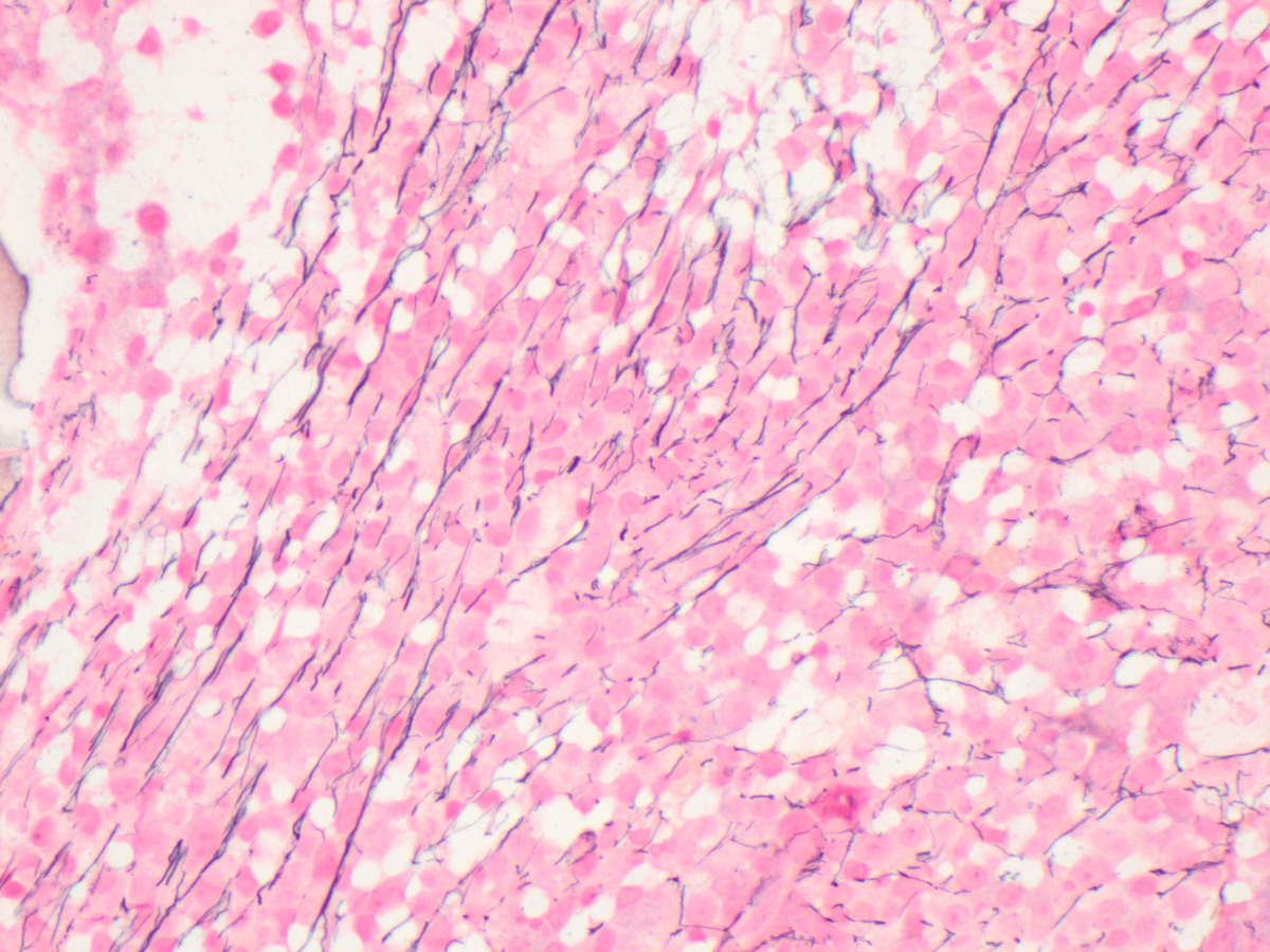 reticulin stain on bone marrow biopsy