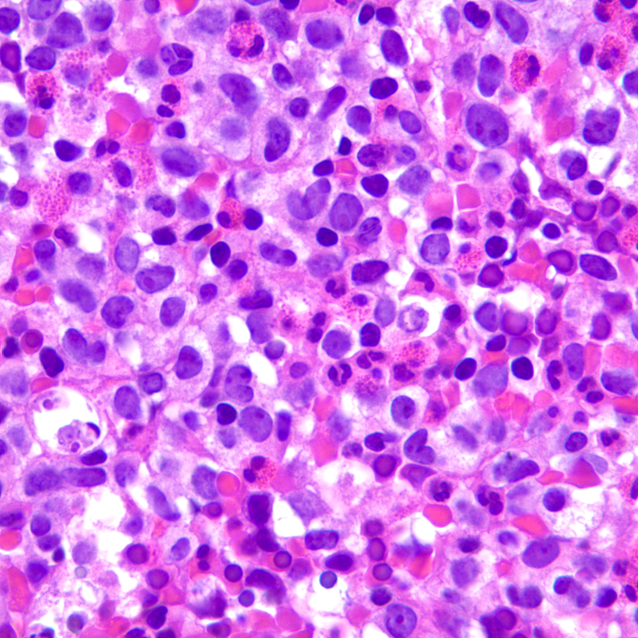 Bone marrow biopsy H&E