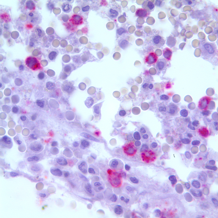 Bone marrow biopsy CD34