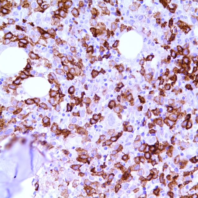 Bone marrow biopsy CD7