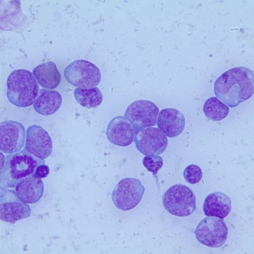 Cytospin of cells from lymph node