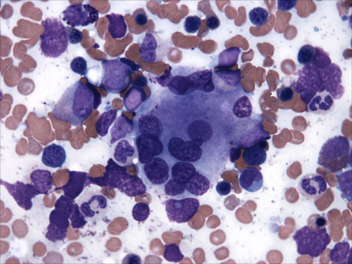 Bone marrow aspirate 2