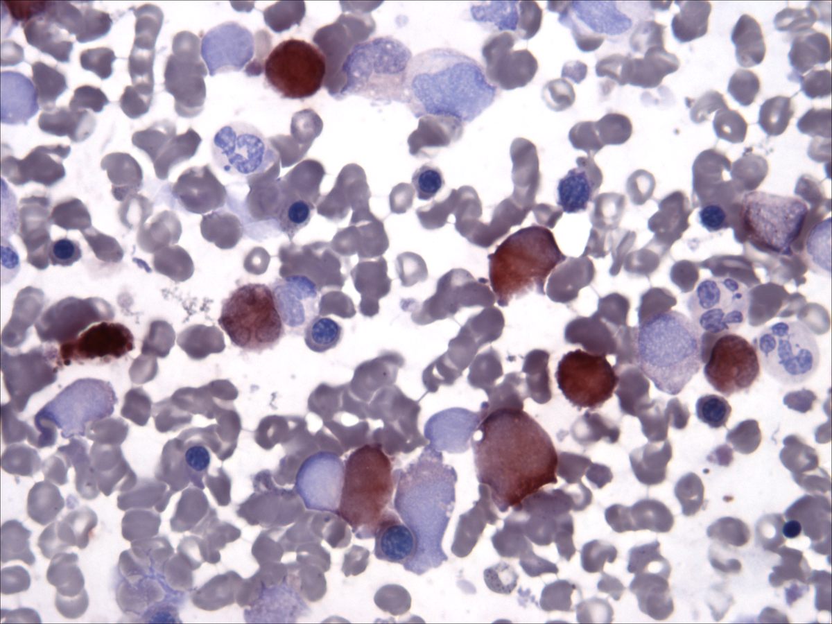 Bone marrow aspirate: butyrate