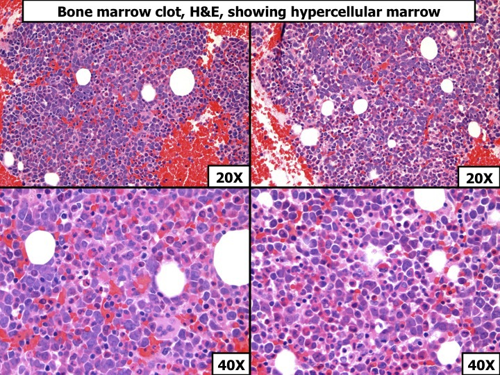 Bone marrow clot section, H&E, showing hypercellular marrow