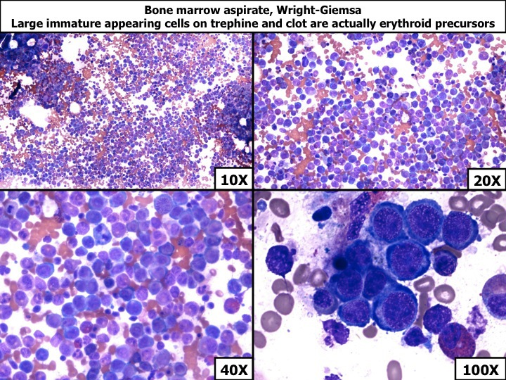 Bone marrow aspirate, Wright-Giemsa, showing that the large immature appearing cells seen on trephine and clot sections are actually erythroid precursors