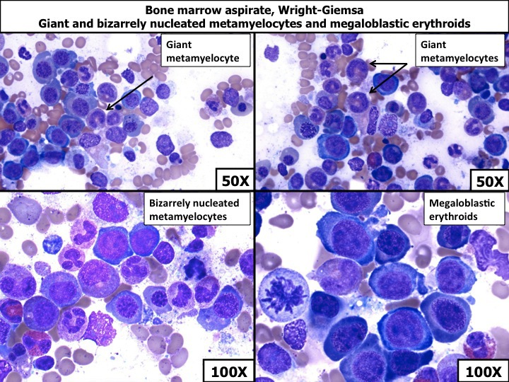 Bone marrow aspirate, Wright-Giemsa, showing giant and bizarrely nucleated metamyelocytes and megaloblastic erythroids
