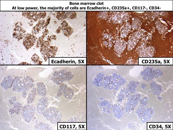 Bone marrow clot, H&E, showing that at low power, the majority of cells are Ecadherin+, CD235a+, CD117-, CD34-