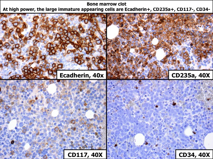 Bone marrow clot, H&E, showing that at high power, the large immature appearing cells are Ecadherin+, CD235a+, CD117-, CD34-