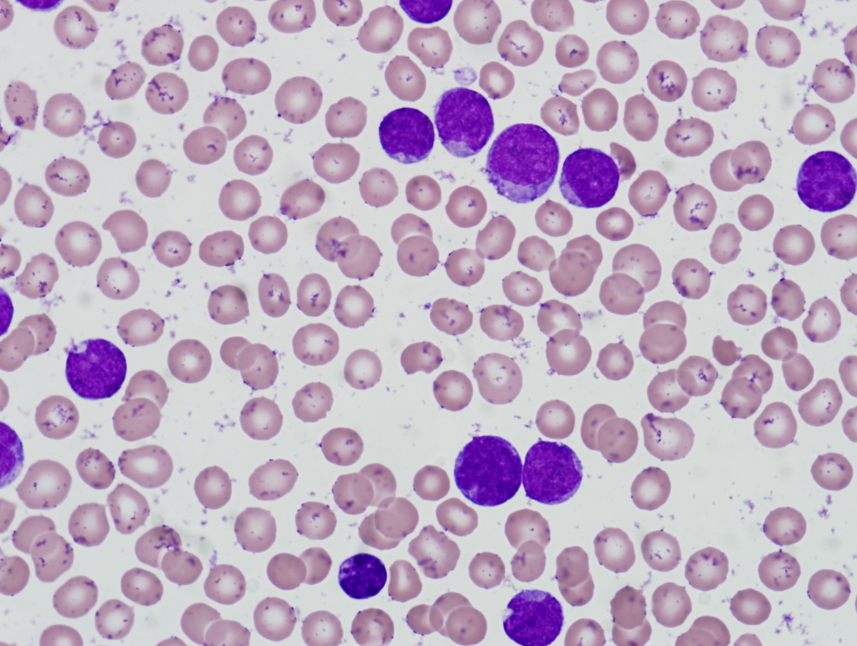 Peripheral blood smear at diagnosis (2/2011)
