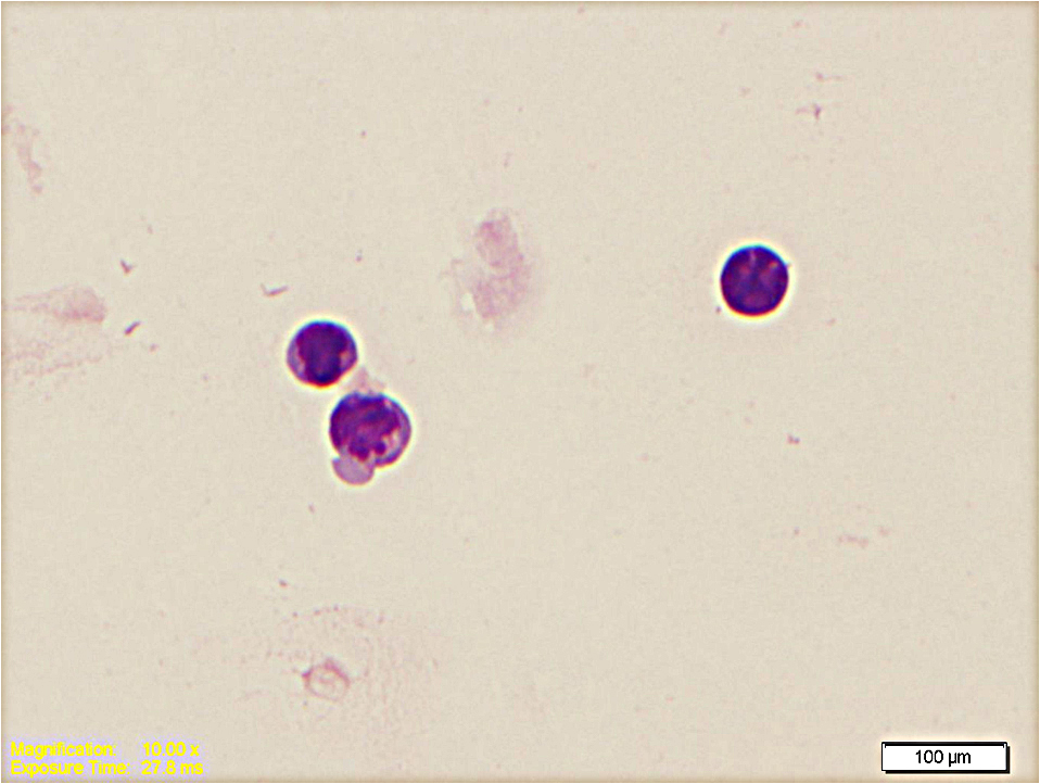 Cerebrospinal fluid showed variable blasts