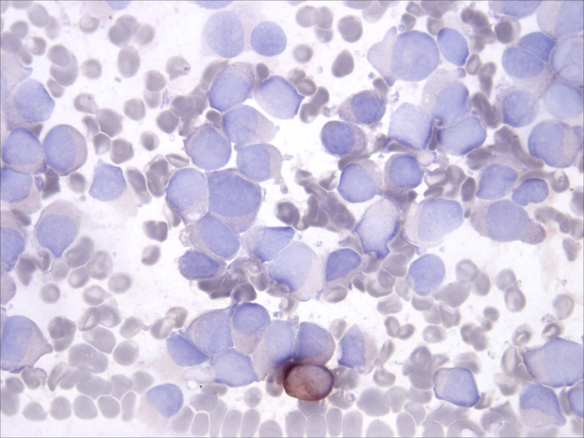 Bone marrow aspirate: butyrate