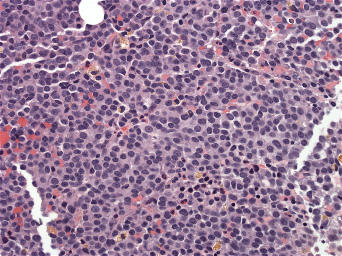 Bone marrow core biopsy 2