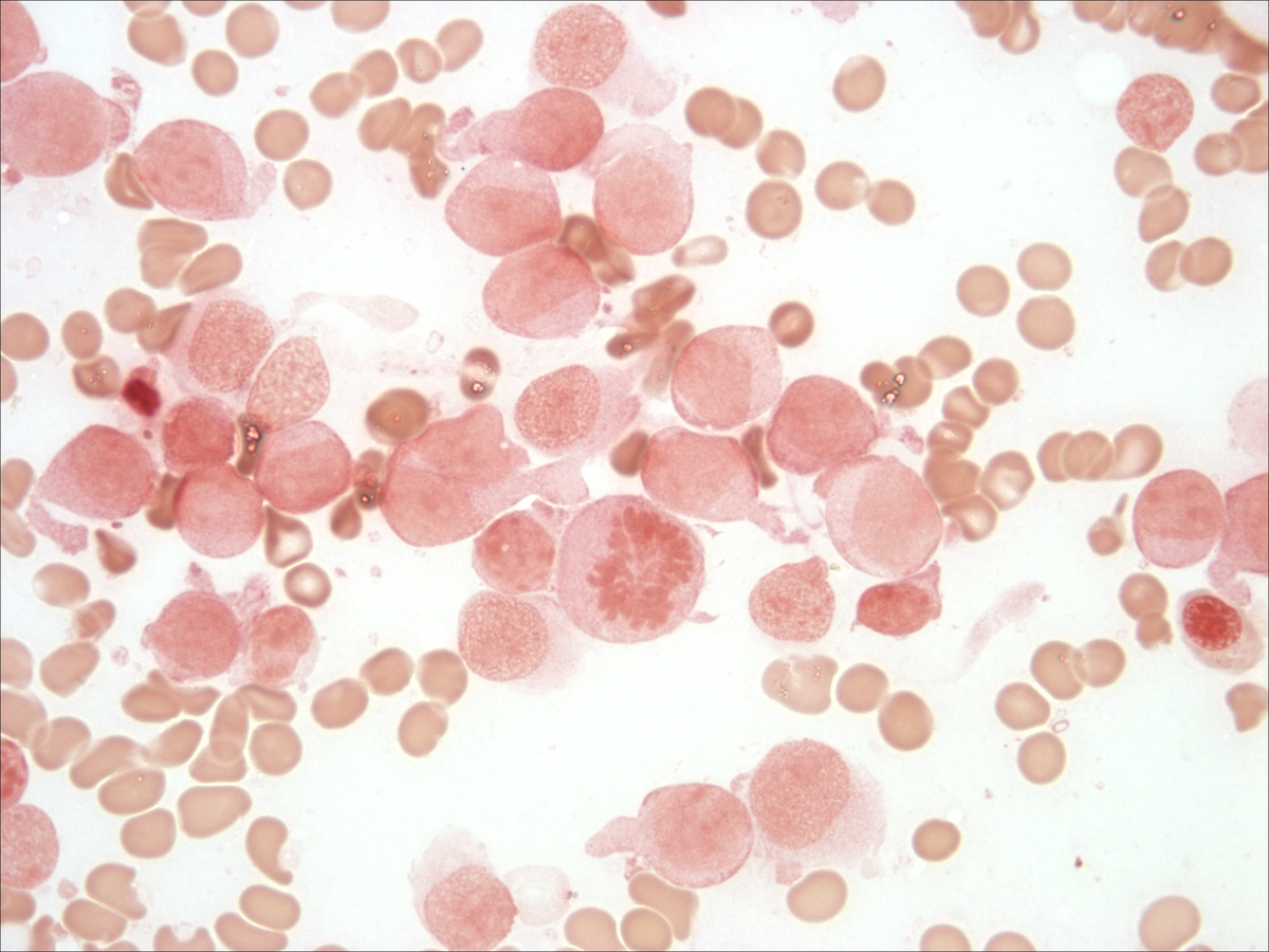 Bone marrow aspirate: myeloperoxidase
