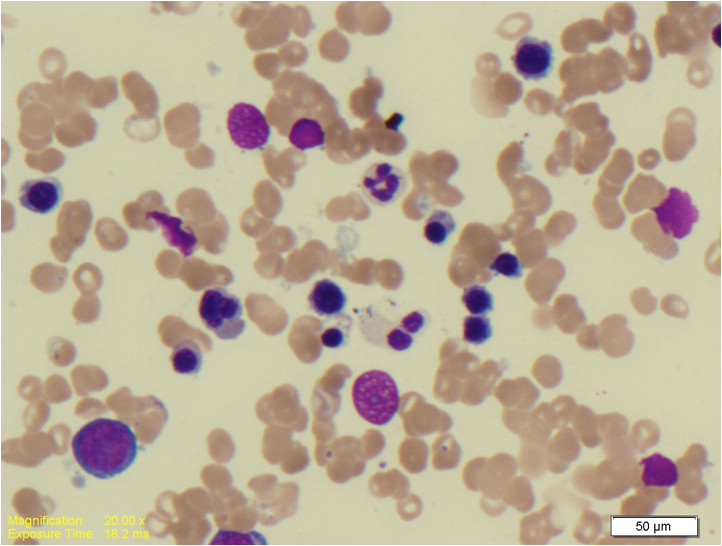 Aspirates revealed erhthyroid dysplasia