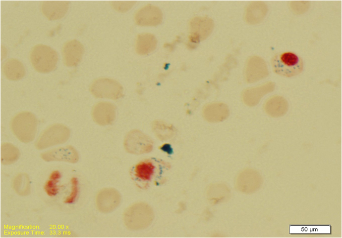 Ring sideroblasts were seen