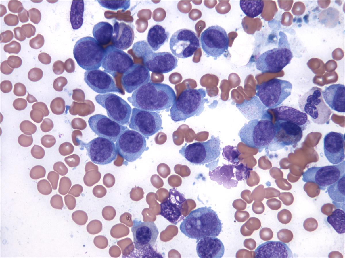 Bone marrow aspirate (06/2012)