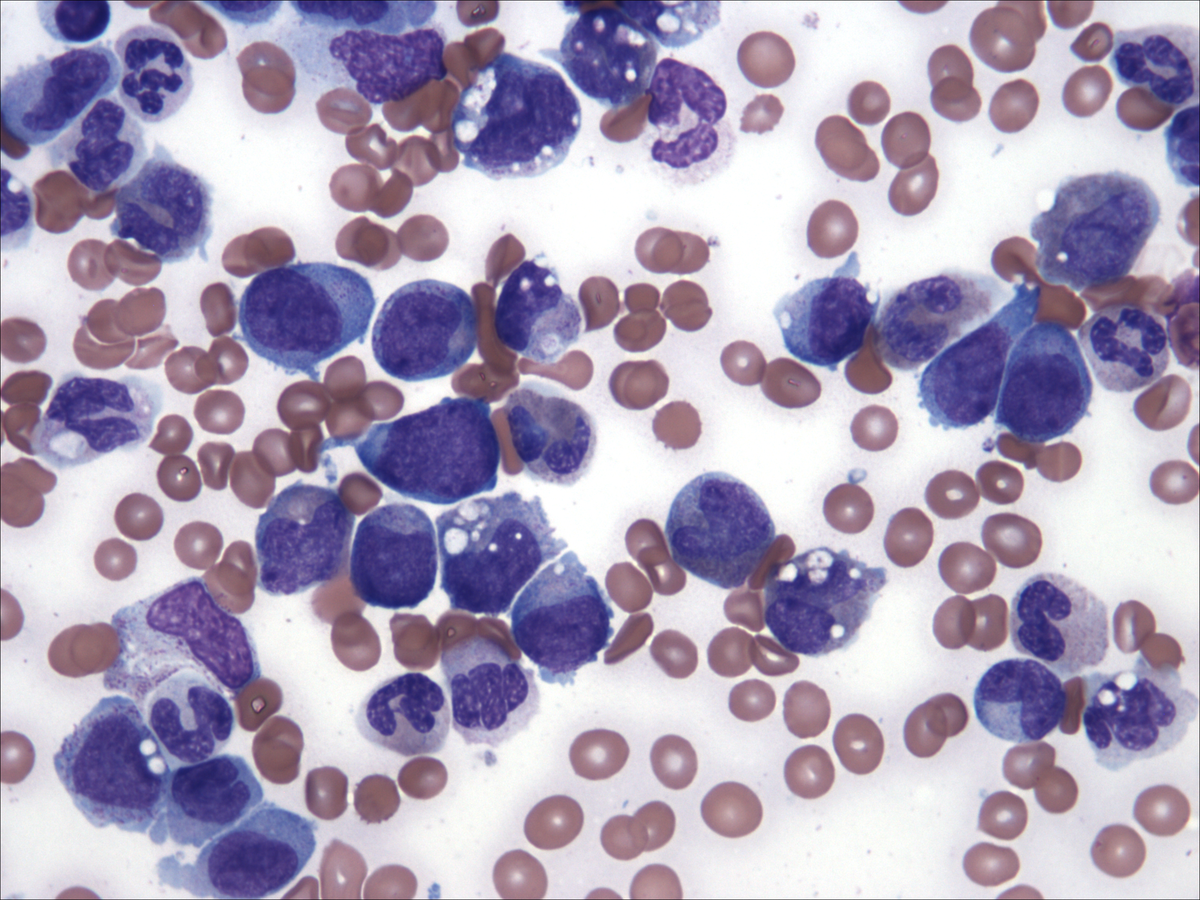 Bone marrow aspirate (5/2012)