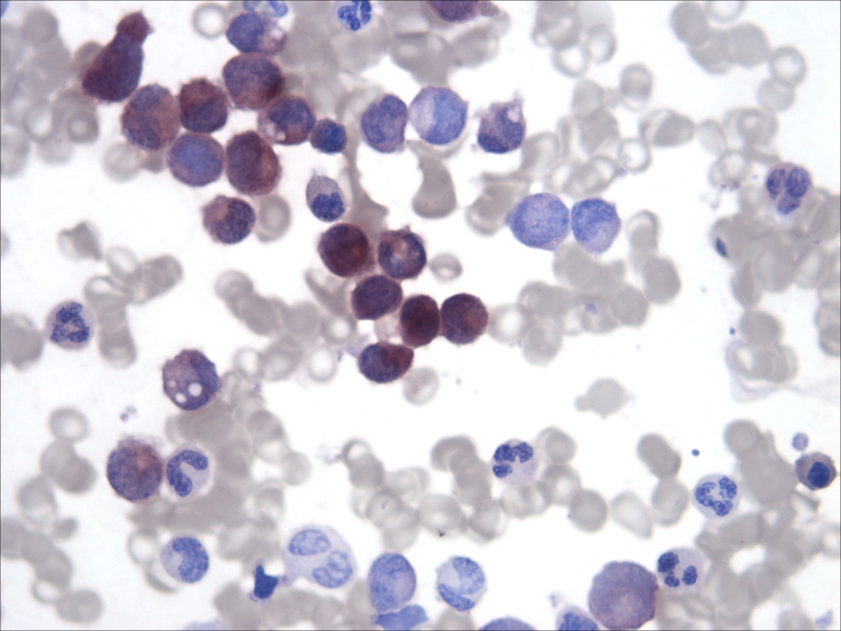 Bone marrow aspirate: butyrate (05/2012)