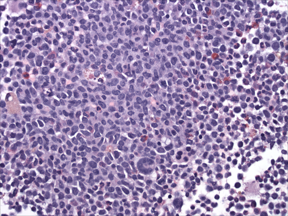 Bone marrow clot (06/2012)
