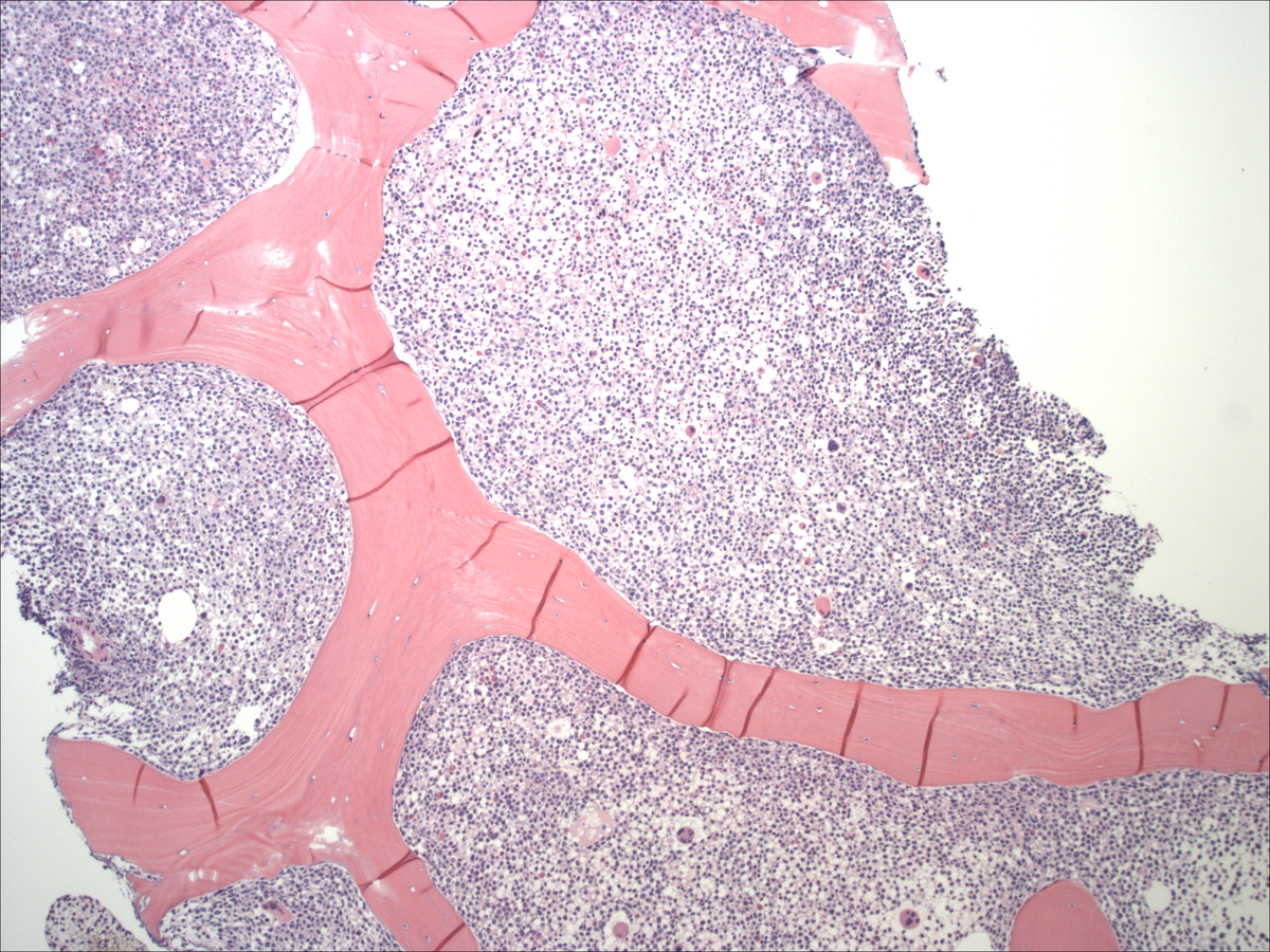 Bone marrow core biopsy 1 (5/2012)