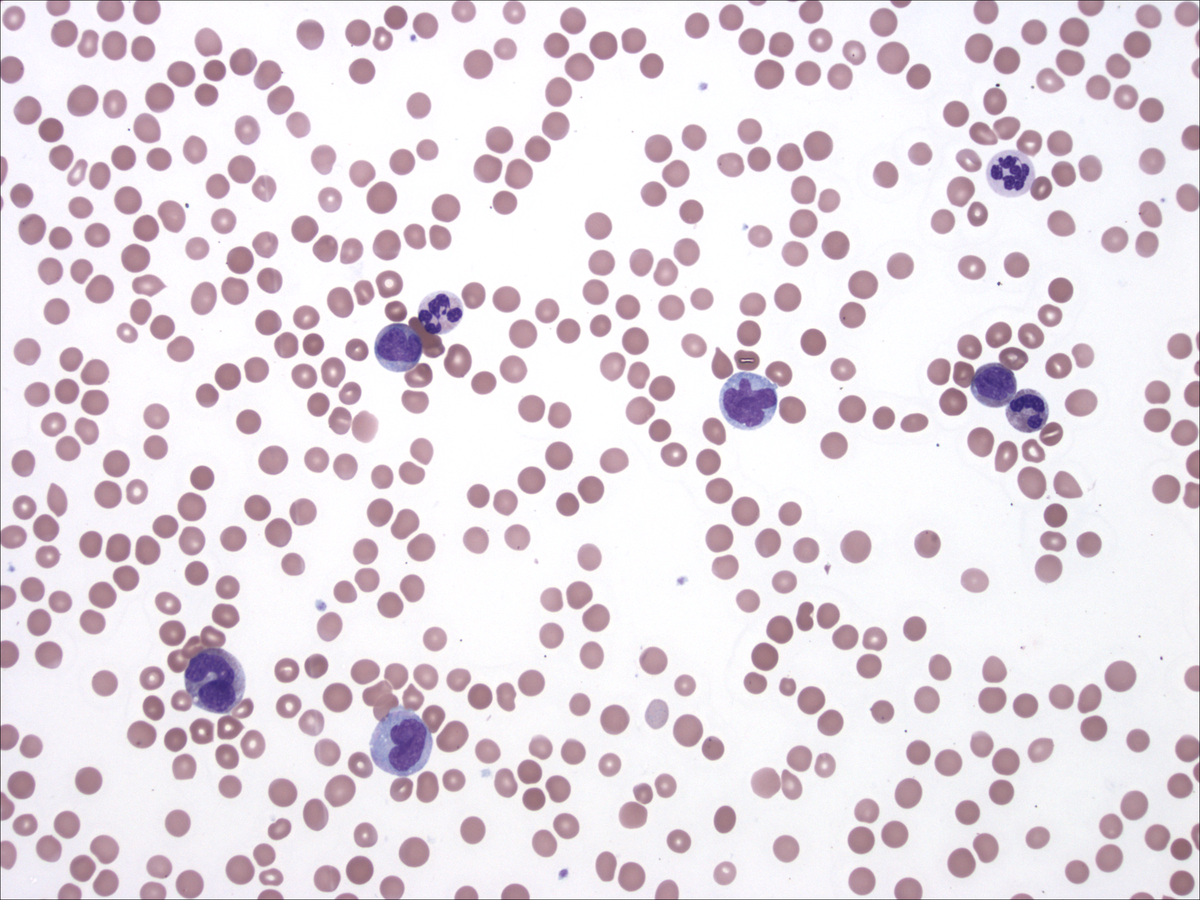 Peripheral blood (05/2012)