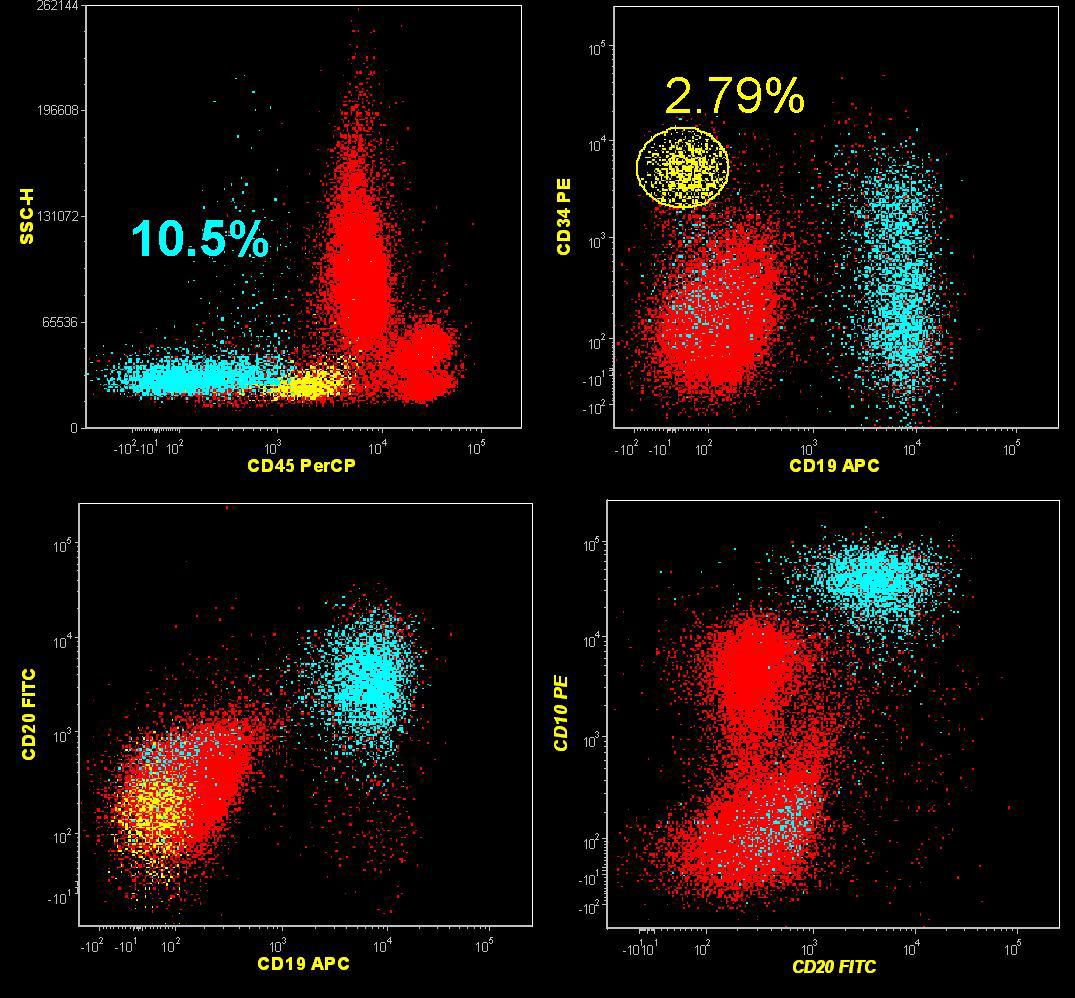 Flow cytometric analysis of BM aspirate with the B-lymphoid blasts (aqua). Myeloid blasts are shown in (yellow)